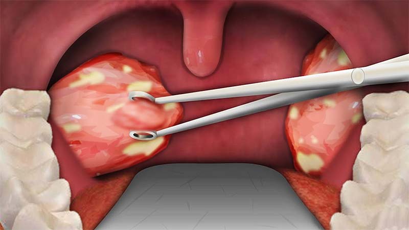 Tonsil and Adenoid Removal Surgery