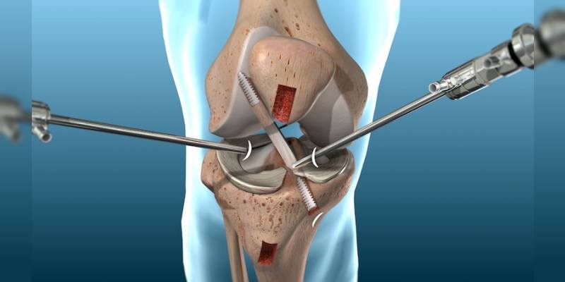 Arthroscopy Treatment