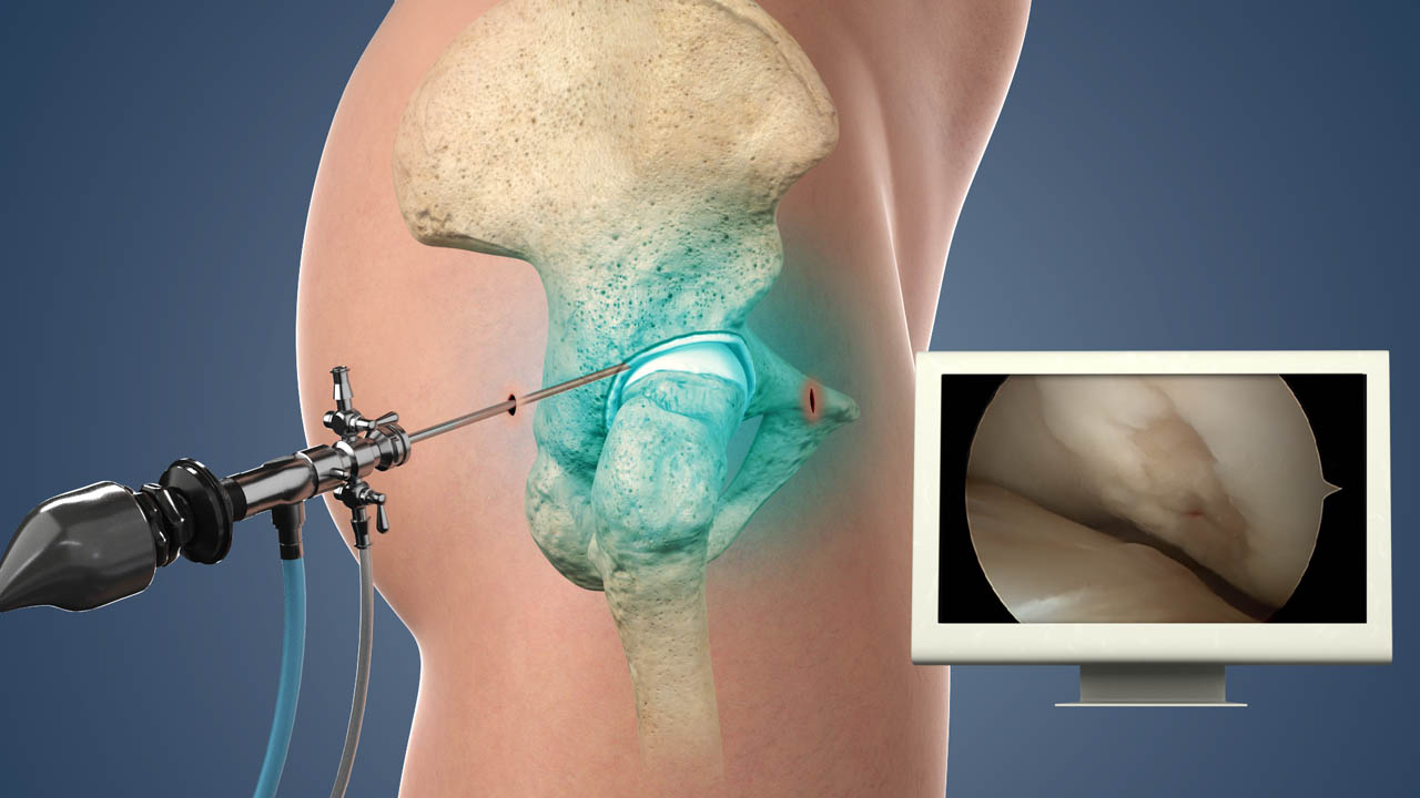 Hip Arthroscopy