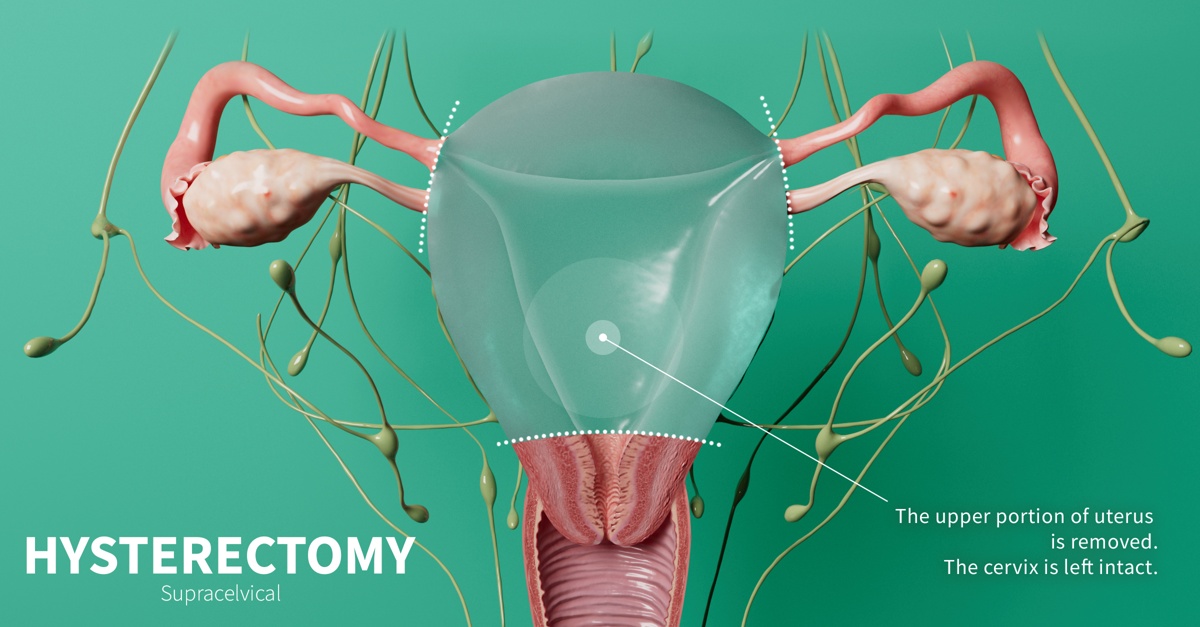 Hysterectomy Surgery