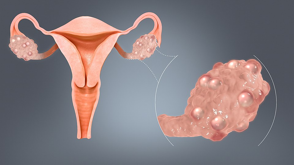 PCOS and Menstrual Disorders